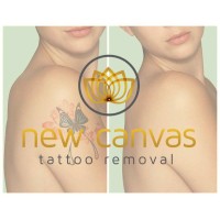 New Canvas Tattoo Removal logo, New Canvas Tattoo Removal contact details